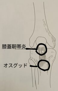 膝蓋靭帯炎とオスグッドの痛む場所