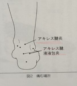 アキレス腱炎とアキレス腱滑液包炎の痛む場所