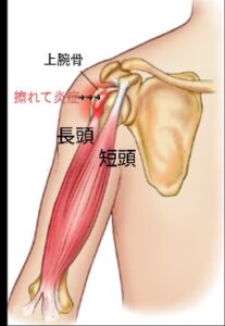 肩の前側の痛み