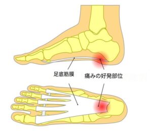 足底筋膜炎の好発部位